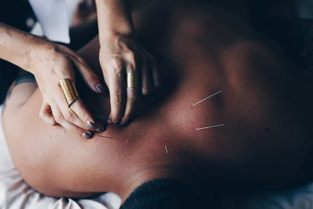What Is Dry Needling - Swolverine